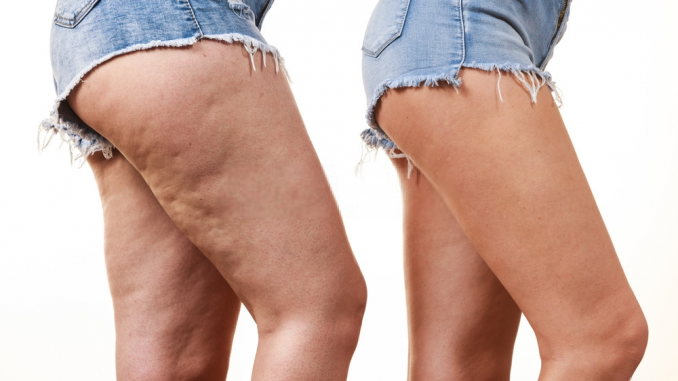 get rid of cellulite